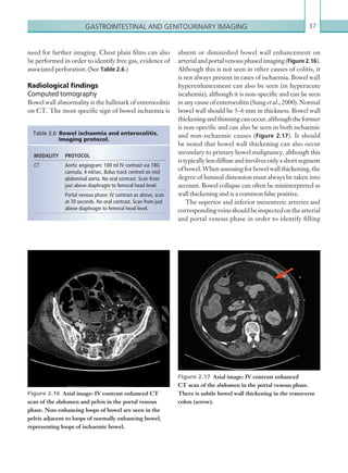 Gastrointestinal and genitourinary imaging 37
need for further imaging. Chest plain films can also
be performed in order to identify free gas, evidence of
associated perforation. (See Table 2.6.)
Radiological findings
Computed tomography
Bowel wall abnormality is the hallmark of enterocolitis
on CT. The most specific sign of bowel ischaemia is
MODALITY PROTOCOL
CT Aortic angiogram: 100 ml IV contrast via 18G
cannula, 4 ml/sec. Bolus track centred on mid
abdominal aorta. No oral contrast. Scan from
just above diaphragm to femoral head level.
Portal venous phase: IV contrast as above, scan
at 70 seconds. No oral contrast. Scan from just
above diaphragm to femoral head level.
Table 2.6 Bowel ischaemia and enterocolitis.
Imaging protocol.
Figure 2.16  Axial image: IV contrast enhanced CT
scan of the abdomen and pelvis in the portal venous
phase. ­Non-enhancing loops of bowel are seen in the
pelvis adjacent to loops of normally enhancing bowel,
­representing loops of ischaemic bowel.
absent or diminished bowel wall enhancement on
arterialandportalvenousphasedimaging(Figure 2.16).
Although this is not seen in other causes of colitis, it
is not always present in cases of ischaemia. Bowel wall
hyperenhancement can also be seen (in hyperacute
iscahemia), although it is non-specific and can be seen
in any cause of enterocolitis (Sung et al., 2000). Normal
bowel wall should be 3–6 mm in thickness. Bowel wall
thickeningandthinningcanoccur,althoughtheformer
is non-specific and can also be seen in both ischaemic
and non-ischaemic causes (Figure 2.17). It should
be noted that bowel wall thickening can also occur
secondary to primary bowel malignancy, although this
istypicallylessdiffuseandinvolvesonlyashortsegment
ofbowel.Whenassessingforbowelwallthickening,the
degree of luminal distension must always be taken into
account. Bowel collapse can often be misinterpreted as
wall thickening and is a common false positive.
The superior and inferior mesenteric arteries and
correspondingveinsshouldbeinspectedonthearterial
and portal venous phase in order to identify filling
Figure 2.17  Axial image: IV contrast enhanced
CT scan of the abdomen in the portal venous phase.
There is subtle bowel wall thickening in the transverse
colon (arrow).
K22247_C002.indd 37 16/05/15 3:07 AM
 