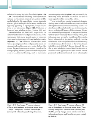 Chapter 238
venous engorgement (Figure 2.23), mesenteric fat
stranding, bowel dilatation and ascites, can also be
seen, regardless of the cause of the colitis.
There is significant overlap between the imaging
findings seen in ischaemia and other causes of colitis,
althoughtherecanbesomediscriminatingfactors. The
distribution of bowel affected is one of the most useful
factors to distinguish between different causes. If bowel
wall abnormality corresponds to a segmental arterial
territory (most commonly the descending colon), then
ischaemia must always be considered. Conversely,
bowel abnormality involving multiple arterial
territories is more likely to be due to an inflammatory
or infective cause. Involvement of the terminal ileum
is highly typical of Crohn’s disease, although this can
also be seen in infective causes. Bowel involvement in
ulcerative colitis typically starts at the rectum, extends
proximally and spares the small bowel (allowing for
defects, which may represent thrombus (Figures 2.18,
2.19). Multiplanar reformatting on wider window
settings and maximum intensity projections (MIPs)
can be helpful in this regard. In the context of embolic
disease, splenic or hepatic infarcts may also be seen,
typically appearing as a peripheral, wedge-shaped
focus of low attenuation (Figure 2.20). Utilisation of
lung and bone window settings (window 600, level
1,600 and window 300, level 2,000, respectively) can
aid in the identification of pneumatosis and portal
venous gas, both more specific signs of ischaemia
when seen in the presence of bowel wall abnormality
(Figures 2.21, 2.22). It should be noted that portal
venous gas and pneumobilia both present as linear, low
attenuation branching structures within the liver. Gas
within the portal venous system often extends to the
liver periphery, whereas gas within the biliary system
does not. Additional findings, such as mesenteric
Figure 2.18  Axial image: IV contrast enhanced
CT scan of the abdomen in the portal venous phase.
There is a filling defect identified within the SMA
(arrow), with colitic changes affecting the caecum.
Figure 2.19  Axial image: IV contrast enhanced CT
scan of the abdomen in the portal venous phase. There
is a large filling defect within the aorta ­extending into
the SMA (arrow). Free gas is seen anterior to the liver.
Ischaemic, perforated small bowel is seen more caudally
on the scan.
K22247_C002.indd 38 16/05/15 3:07 AM
 