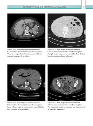 Gastrointestinal and genitourinary imaging 39
Figure 2.20  Axial image: IV contrast enhanced
CT scan of the abdomen in the portal venous phase.
There is a wedge-shaped low attenuation within the
spleen in keeping with an infarct.
Figure 2.21  Axial image: IV contrast enhanced
CT scan of the abdomen in the portal venous phase.
­Multiple locules of gas can be seen within the wall of the
bowel, secondary to bowel ischaemia.
Figure 2.22  Axial images: IV contrast enhanced
CT scan of the abdomen in the portal venous phase.
Large volumes of portal venous gas are seen within the
liver extending to the periphery.
Figure 2.23  Axial image: IV contrast enhanced
CT scan of the abdomen in the portal venous phase.
The mesenteric vessels are engorged and the mesenteric
fat has a hazy appearance.
K22247_C002.indd 39 16/05/15 3:07 AM
 