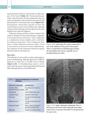 Chapter 240
backwash ileitis). Infective enterocolitis can affect any
part of the bowel (Table 2.7). Pseudomembranous
colitis commonly affects the descending and transverse
colon and typically causes much more pronounced wall
thickening (10–15 mm) than other causes (Figure 2.24).
Neutropaenic enterocolitis typically involves the
terminal ileum, caecum and ascending colon, although
ahistoryofchemotherapyandneutropaeniaisthemost
helpful tool to make this diagnosis.
Utilisation of lung and bone window settings is also
useful to identify free intra-abdominal gas, suggestive
of associated bowel perforation. Toxic megacolon
is a complication of most colitides and is a risk factor
for imminent perforation. This is diagnosed when
there is colonic dilatation (transverse colon 6 cm)
in the presence of associated colonic inflammation.
Any suspicion of toxic megacolon should be urgently
discussed with the referring team.
Plain films
The hallmark of enterocolitis on plain radiographs is
bowel wall thickening, although again this is a difficult
diagnosis to make due to variable bowel collapse
(Figure 2.25). A ‘thumbprinting’ pattern can be
observed in the colon, representing thickened haustral
folds, although this has a wide differential.
CAUSATIVE ORGANISM DISTRIBUTION
Clostridium difficile
(pseudomembranous colitis)
Descending and transverse
colon.
Salmonella spp. Colonic inflammation only.
Campylobacter spp. Typically in distal colon.
Yersinia spp. Typically terminal ileum and
caecum.
Mycobacterium spp. Typically terminal ileum and
caecum.
Entamoeba histolytica Diffuse colonic involvement,
typically ascending colon.
Shigella spp. Typically rectosigmoid colon.
Table 2.7 Typical distribution of infective
colitides.
Figure 2.24  Axial image: IV contrast enhanced CT
scan of the abdomen in the portal venous phase.
There is marked bowel wall thickening ­involving
the ­descending colon (arrow), typically seen in
­pseudomembranous colitis.
Figure 2.25  Supine abdominal radiograph. There is
thickening of the bowel wall involving the descending
colon (arrow), consistent with colitis. No intraperitoneal
free gas is seen.
K22247_C002.indd 40 16/05/15 3:07 AM
 