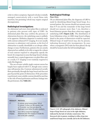 Chapter 242
Radiological findings
Plain films
On an abdominal plain film, the diagnosis of LBO is
made by identifying dilated large bowel loops. In a
normal patient, the caecum should not measure more
than 8–9 cm and the remainder of the large bowel
should not measure more than 5 cm, therefore a
bowel diameter greater than these values may suggest
underlying LBO (Figure 2.26). The distribution of
bowel dilatation is key; in LBO, large bowel collapse
distal to the point of obstruction would be expected.
Dilated loops of small bowel may also be present,
indicating ileocaecal valve incompetence. In cases
where a nasogastric (NG) tube has been placed, the tip
should be located under the left hemidiaphragm.
order to relieve symptoms. Sigmoid volvulus is initially
managed conservatively with a rectal flatus tube
insertion, but persisting volvuli may require surgical
decompression.
Radiological investigations
An abdominal and erect chest plain film is indicated
in patients who present with signs of LBO. An
abdominal plain film may confirm the presence of
obstruction; however, the underlying cause is unlikely
to be apparent. Definitive diagnosis is routinely made
with contrast enhanced CT imaging. It is not usually
necessary to administer oral contrast, as the level of
obstruction is usually identifiable as an abrupt calibre
change or mass. Furthermore, patients who are acutely
obstructed are unlikely to be able to ingest the volume
of oral contrast required to adequately opacify the
bowel. It is important to note that large bowel volvulae
normally have a typical appearance on plain films and,
as a result, CT imaging is not routinely required to
make this diagnosis.
The use of water soluble single contrast enema has
largely been replaced with CT, though some centres
may still practise this. Contrast administered rectally
flows proximally through the large bowel and does not
pass beyond the point of obstruction. If the procedure
is performed, water soluble contrast should be used due
to the risk of bowel perforation and hence leakage into
the peritoneum. (See Table 2.8.)
MODALITY PROTOCOL
CT IV contrast, portal venous phase: 100 ml
IV contrast, 4 ml/sec via 18G cannula. Scan
at 70 seconds. Scan from just above the
­diaphragm to just below the pubic symphysis.
Plain film
imaging
Erect CXR to include the diaphragm.
­Abdominal plain film imaging to include the
liver to the pubic symphysis.
Table 2.8 Large bowel obstruction. Imaging
protocol.
Figure 2.26  AP radiograph of the abdomen. Dilated
loops of large bowel are seen in the right abdomen,
­indicated by the lack of valvulae conniventes. The
­ileocaecal valve is patent, resulting in reflux of gas into
small bowel loops seen centrally and in the left abdomen.
K22247_C002.indd 42 16/05/15 3:07 AM
 