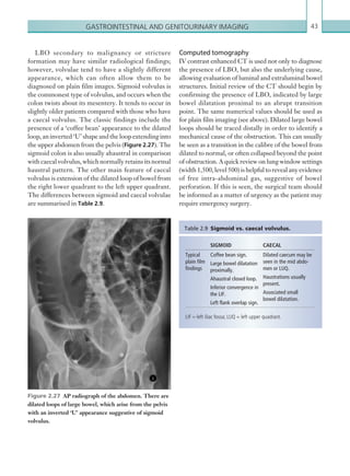 Gastrointestinal and genitourinary imaging 43
LBO secondary to malignancy or stricture
formation may have similar radiological findings;
however, volvulae tend to have a slightly different
appearance, which can often allow them to be
diagnosed on plain film images. Sigmoid volvulus is
the commonest type of volvulus, and occurs when the
colon twists about its mesentery. It tends to occur in
slightly older patients compared with those who have
a caecal volvulus. The classic findings include the
presence of a ‘coffee bean’ appearance to the dilated
loop, an inverted ‘U’ shape and the loop extending into
the upper abdomen from the pelvis (Figure 2.27). The
sigmoid colon is also usually ahaustral in comparison
with caecal volvulus, which normally retains its normal
haustral pattern. The other main feature of caecal
volvulus is extension of the dilated loop of bowel from
the right lower quadrant to the left upper quadrant.
The differences between sigmoid and caecal volvulae
are summarised in Table 2.9.
SIGMOID CAECAL
Typical
plain film
findings
Coffee bean sign.
Large bowel dilatation
proximally.
Ahaustral closed loop.
Inferior convergence in
the LIF.
Left flank overlap sign.
Dilated caecum may be
seen in the mid abdo-
men or LUQ.
Haustrations usually
present.
Associated small
bowel dilatation.
LIF = left iliac fossa; LUQ = left upper quadrant.
Table 2.9  Sigmoid vs. caecal volvulus.
Computed tomography
IV contrast enhanced CT is used not only to diagnose
the presence of LBO, but also the underlying cause,
allowing evaluation of luminal and extraluminal bowel
structures. Initial review of the CT should begin by
confirming the presence of LBO, indicated by large
bowel dilatation proximal to an abrupt transition
point. The same numerical values should be used as
for plain film imaging (see above). Dilated large bowel
loops should be traced distally in order to identify a
mechanical cause of the obstruction. This can usually
be seen as a transition in the calibre of the bowel from
dilated to normal, or often collapsed beyond the point
of obstruction. A quick review on lung window settings
(width 1,500, level 500) is helpful to reveal any evidence
of free intra-abdominal gas, suggestive of bowel
perforation. If this is seen, the surgical team should
be informed as a matter of urgency as the patient may
require emergency surgery.
Figure 2.27  AP radiograph of the abdomen. There are
dilated loops of large bowel, which arise from the pelvis
with an inverted ‘U’ appearance suggestive of sigmoid
volvulus.
K22247_C002.indd 43 16/05/15 3:07 AM
 