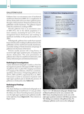 Chapter 246
GALLSTONE ILEUS
Gallstone ileus is an uncommon cause of mechanical
small bowel obstruction (SBO). It is a complication of
chroniccholecystitisandoccurswhenagallstonepasses
through a cholecystenteric fistula located between the
gallbladder and the duodenum. The gallstone impacts
within the small bowel, resulting in SBO.
Overall, gallstone ileus is an uncommon cause
of SBO (4%), but in the elderly population it is
more common, accounting for up to 25% of non-
strangulated bowel obstructions and resulting in
significant morbidity in this group (Lassandro et al.,
2005).
Pathologically, gallstone ileus results from repeated
boutsofcholecystitisresultinginadhesionsbetweenthe
gallbladder and the small bowel (usually duodenum),
eventually leading to fistula formation and passage of
gallstones into the lumen of the bowel.
Patients usually present with a long history of
recurrent right upper quadrant pain, in keeping with
chronic cholecystitis. The acute presentation of
gallstone ileus is that of a small bowel obstruction, with
colicky abdominal pain and abdominal distension.
Radiological investigations
A plain abdominal radiograph is useful as a first-line
investigationinpatientswithsuspectedSBO.Suspicion
of gallstone ileus on plain film imaging necessitates
CT imaging of the abdomen, which has a sensitivity,
specificity and accuracy of diagnosing gallstone ileus
of 93%, 100% and 99%, respectively (Yu et al., 2005).
Ultrasound is useful in assessment of patients with
right upper quadrant pain to identify the presence of
gallstones or cholecystitis. (See Table 2.10.)
Radiological findings
Plain films
The classic findings on an abdominal radiograph are of
SBO (dilated loops of small bowel 2.5 cm), gas within
the biliary tree (linear branching lucencies projected
over the right upper quadrant) and a gallstone (usually
in the right iliac fossa) (Figure 2.31). This is known as
Rigler’s triad.
MODALITY PROTOCOL
CT IV contrast, portal venous phase:
100 ml IV contrast, 4 ml/sec via 18G
cannula. Scan at 70 seconds. Scan
from just above the diaphragm to just
below the pubic symphysis.
Plain film imaging Abdominal plain film imaging
to ­include the liver to the pubic
­symphysis.
Ultrasound 1–5MHz curvilinear probe.
Table 2.10  Galltone ileus. Imaging protocol.
Figure 2.31  AP abdominal radiograph. Multiple loops
of dilated small bowel can be seen, consistent with
SBO. Linear, branching lucencies can be seen at the
right upper quadrant consistent with biliary gas (arrow).
The ­findings are consistent with gallstone ileus. No
­radiopaque ­gallstone can be seen on the radiograph.
K22247_C002.indd 46 16/05/15 3:07 AM
 