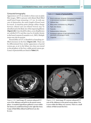 Gastrointestinal and genitourinary imaging 47
Computed tomography
Appearances on CT are similar to those seen on plain
film images. SBO is present with dilated fluid-filled
small bowel loops measuring 3.5 cm. As with any
case of obstruction, the entire length of bowel must
be traced. A transition point (abrupt calibre change
between dilated and non-dilated bowel) may be
identified and is the likely site of the impacted gallstone
(Figure 2.32). Care should be taken, as not all gallstones
are calcified (12%) and they may be of similar density
to the bowel contents (Lassandro et al., 2005). Multiple
stones may also be present.
Pneumobilia on CT is identified as branching air-
filled structures in the liver (Figure 2.33). These can
be differentiated from similar appearances of portal
venous gas, as air in the biliary tree does not extend
to the periphery of the liver, unlike portal venous gas.
Causes of pneumobilia are listed in Table 2.11.
Figure 2.33  Axial image: IV contrast enhanced CT
scan of the abdomen in the portal venous phase. Gas
is seen within the biliary tree (arrow). There is a small
volume of fluid around the liver.
•	 Recent endoscopic retrograde cholangiopancreatography
or percutaneous transhepatic cholangiography.
•	 Gallstone ileus.
•	 Biliary enteric anastomosis (e.g. Whipple’s).
•	 Peptic ulcer disease.
•	 Traumatic.
•	 Emphysematous cholecystitis.
•	 Incompetent sphincter of Oddi (sphicterotomy, chronic
pancreatitis and passage of stone).
•	 Congenital.
Table 2.11  Causes of ­pneumobilia.
Figure 2.32  Axial image: IV contrast enhanced CT
scan of the abdomen and pelvis in the portal venous
phase. A rounded, hyperdense gallstone is seen within
the lumen of a small bowel loop in the right iliac fossa.
Loops of fluid-filled, dilated small bowel can also
be seen.
K22247_C002.indd 47 16/05/15 3:07 AM
 