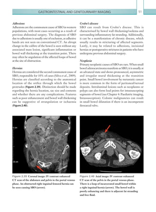 Gastrointestinal and genitourinary imaging 51
Crohn’s disease
SBO can result from Crohn’s disease. This is
characterised by bowel wall thickening/oedema and
surrounding inflammatory fat stranding. Additionally,
it can be a manifestation of chronic disease, which
usually results in stricturing of affected segments.
Lastly, it may be related to adhesions, incisional
hernias or postoperative strictures in patients who have
undergone previous abdominal surgery.
Neoplasia
Primary neoplastic causes of SBO are rare. When small
boweladenocarcinomamanifestsasSBO,itisusuallyat
an advanced state and shows pronounced, asymmetric
and irregular mural thickening at the transition
point. Small bowel involvement by metastatic cancer
is more common in the form of peritoneal/serosal
deposits. Intraluminal lesions such as neoplasms or
polyps can also form lead points for intussuscepting
segments of bowel (see Chapter 4: Paediatric imaging,
Intussusception). Colonic malignancies can result
in small bowel dilatation if there is an incompetent
ileocaecal valve.
Adhesions
Adhesions are the commonest cause of SBO in western
populations, with most cases occurring as a result of
previous abdominal surgery. The diagnosis of SBO
due to adhesions is usually one of exclusion, as adhesive
bands are not seen on conventional CT. An abrupt
change in the calibre of the bowel is seen without any
associated mass lesion, significant inflammation or
bowel wall thickening at the transition point. There
may often be angulation of the affected loops of bowel
at the site of obstruction.
Hernias
Hernias are considered the second commonest cause of
SBO, responsible for 10% of cases (Silva et al., 2009).
Hernias are classified according to the anatomical
location of the orifice through which the bowel
protrudes (Figure 2.39). Distinction should be made
regarding the hernia location, sac size and contents
and whether there are any complications. Features
such as poor enhancement and bowel wall thickening
can be suggestive of strangulation or ischaemia
(Figure 2.40).
Figure 2.39  Coronal image: IV contrast enhanced
CT scan of the abdomen and pelvis in the portal venous
phase. An obstructed right inguinal femoral hernia can
be seen causing SBO (arrow).
Figure 2.40  Axial image: IV contrast enhanced
CT scan of the pelvis in the portal venous phase.
There is a loop of incarcerated small bowel within
a right inguinal hernia (arrow). The bowel wall is
poorly enhancing and there is adjacent fat stranding
and free fluid.
K22247_C002.indd 51 16/05/15 3:07 AM
 