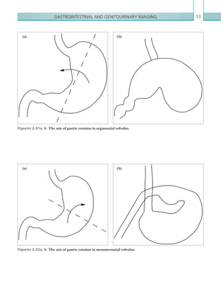 Gastrointestinal and genitourinary imaging 53
Figures 2.41a, b  The axis of gastric rotation in organoaxial volvulus.
(a) ( b)
Figures 2.42a, b  The axis of gastric rotation in mesenteroaxial volvulus.
(a) ( b)
K22247_C002.indd 53 16/05/15 3:07 AM
 