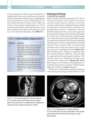 Chapter 254
Radiological findings
Computed tomography
Gastric volvulus should be suspected on CT with an
abnormal orientation of the stomach. The greater
curvature should always lie inferior to the lesser
curvature and the gastro-oesophageal junction should
be positioned to the left and more cranial than the
gastroduodenal junction. Multiplanar reformats
should be utilised in order to more easily appreciate
the anatomical orientation of the stomach, particularly
the coronal view, which mirrors the standard supine
view obtained by fluoroscopy and plain film imaging.
An organoaxial orientation of the stomach is diagnosed
when the greater curvature is positioned more cranially
than the lesser curvature, while a mesenteroaxial
orientation occurs when the antrum is more cranial
than the gastro-oesophageal junction (Figure 2.43).
Mixed subtype gastric volvulae are diagnosed when
the stomach orientation fulfils the criteria for both
the organoaxial and mesenteroaxial orientation. The
stomach may lie in an intrathoracic position when
associated with a hiatus hernia (Figure 2.44). Note:
Both subtypes can be chronic and asymptomatic; in
incidental cases the term ‘orientation’ should be used as
opposed to ‘volvulus’ to highlight this point.
Obstruction is indicated by significant dilatation
of the closed gastric loop, proximal dilatation of the
several advantages over fluoroscopy: identification of
complicating factors such as perforation and gastric
ischaemia, associated conditions such as diaphragmatic
hernia and alternative causes of abdominal pain. CT
can be performed with or without water soluble oral
contrast. Oral contrast administration can aid the
assessmentofthedegreeofobstruction;however,itcan
limit interpretation of gastric wall enhancement and
may not be tolerated by the patient. (See Table 2.13.)
MODALITY PROTOCOL
CT Portal venous phase: 100 ml IV contrast via
18G cannula, 4 ml/sec. Scan at 70 seconds
after initiation of injection. Oral contrast:
50 ml water soluble oral contrast diluted
in 500 ml water. Administer just prior to
­scanning. Scan from mid thorax to femoral
head level.
Fluoroscopy Water soluble contrast (iodine concentration
300 mg/l) administered orally. Barium can
cause mediastinitis and in general should not
be used (although advocates argue barium
increases the sensitivity of detecting small
leaks when water soluble contrast has failed
to do so).
Table 2.13  Gastric volvulus. Imaging protocol.
Figure 2.43  Coronal image: IV contrast enhanced
CT scan of the thorax and abdomen in the arterial
phase. The stomach has an ‘upside down’ configuration
­consistent with an organoaxial gastric volvulus.
Figure 2.44  Axial image: IV contrast enhanced
CT scan of the thorax in the arterial phase. The ­majority
of the stomach lies within the thorax due to a large
hiatus hernia.
K22247_C002.indd 54 16/05/15 3:07 AM
 
