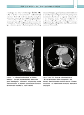 Gastrointestinal and genitourinary imaging 55
oesophagus and distal bowel collapse (Figures 2.45,
2.46). In studies where oral contrast is administered,
complete hold of contrast signifies complete
obstruction, although it should be emphasised that
some contrast passage can still occur in cases of severe
obstruction. Gastric wall thickening, pneumatosis
(gas within the gastric wall, best appreciated on lung
window settings) and poor gastric enhancement should
all raise the suspicion of gastric ischaemia, an important
complication that should be urgently communicated
to the referring team. Free gas is indicative of
perforation and can be seen in both the peritoneum and
mediastinum, depending on the site of the perforated
portion of the stomach.
Figure 2.45  Oblique coronal image: IV contrast
enhanced CT scan of the abdomen and pelvis in the
portal venous phase. The stomach is significantly dilated
and demonstrates an abnormal configuration, suggestive
of obstruction secondary to gastric volvulus.
Figure 2.46  Axial image: IV contrast enhanced
CT scan of the thorax in the arterial phase. The
­proximal stomach is dilated and fluid filled as a result of
­obstruction. The distal stomach beyond the obstruction
is collapsed.
K22247_C002.indd 55 16/05/15 3:07 AM
 