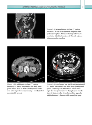 Gastrointestinal and genitourinary imaging 61
Figure 2.52  Coronal image: oral and IV contrast
enhanced CT scan of the abdomen and pelvis in the
portal venous phase. A thick-walled appendix can be
seen in the right iliac fossa (arrow). There is adjacent
inflammatory fat stranding.
Figure 2.53  Axial image: oral and IV contrast
enhanced CT scan of the abdomen and pelvis in the
portal venous phase. A thick-walled appendix can be
seen in the right iliac fossa containing a round calcified
appendicolith (arrow).
Figure 2.54  Axial image: oral and IV contrast enhanced
CT scan of the abdomen and pelvis in the portal venous
phase. A relatively well-defined mass is seen in the
right iliac fossa just anterior to the right psoas muscle
(arrow). An abscess has formed around the appendix,
with inflammatory changes visible around the mass.
K22247_C002.indd 61 16/05/15 3:07 AM
 