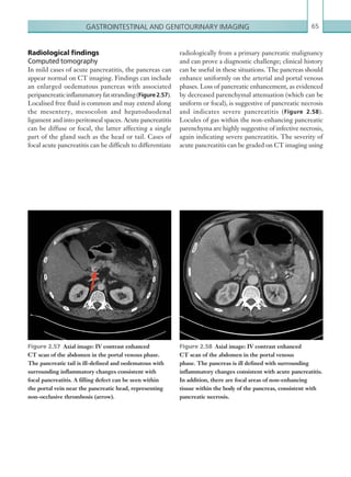 Gastrointestinal and genitourinary imaging 65
radiologically from a primary pancreatic malignancy
and can prove a diagnostic challenge; clinical history
can be useful in these situations. The pancreas should
enhance uniformly on the arterial and portal venous
phases. Loss of pancreatic enhancement, as evidenced
by decreased parenchymal attenuation (which can be
uniform or focal), is suggestive of pancreatic necrosis
and indicates severe pancreatitis (Figure 2.58).
Locules of gas within the non-enhancing pancreatic
parenchyma are highly suggestive of infective necrosis,
again indicating severe pancreatitis. The severity of
acute pancreatitis can be graded on CT imaging using
Figure 2.58  Axial image: IV contrast enhanced
CT scan of the abdomen in the portal venous
phase. The pancreas is ill defined with surrounding
­inflammatory changes consistent with acute ­pancreatitis.
In addition, there are focal areas of non-enhancing
tissue within the body of the pancreas, consistent with
pancreatic necrosis.
Figure 2.57  Axial image: IV contrast enhanced
CT scan of the abdomen in the portal venous phase.
The pancreatic tail is ill-defined and oedematous with
surrounding inflammatory changes consistent with
focal ­pancreatitis. A filling defect can be seen within
the portal vein near the pancreatic head, representing
non-occlusive ­thrombosis (arrow).
Radiological findings
Computed tomography
In mild cases of acute pancreatitis, the pancreas can
appear normal on CT imaging. Findings can include
an enlarged oedematous pancreas with associated
peripancreaticinflammatoryfatstranding(Figure 2.57).
Localised free fluid is common and may extend along
the mesentery, mesocolon and hepatoduodenal
ligament and into peritoneal spaces. Acute pancreatitis
can be diffuse or focal, the latter affecting a single
part of the gland such as the head or tail. Cases of
focal acute pancreatitis can be difficult to differentiate
K22247_C002.indd 65 16/05/15 3:07 AM
 