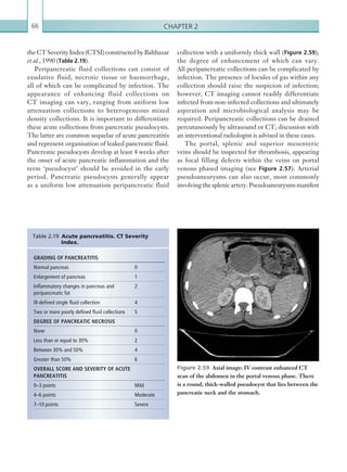 Chapter 266
collection with a uniformly thick wall (Figure 2.59),
the degree of enhancement of which can vary.
All peripancreatic collections can be complicated by
infection. The presence of locules of gas within any
collection should raise the suspicion of infection;
however, CT imaging cannot readily differentiate
infected from non-infected collections and ultimately
aspiration and microbiological analysis may be
required. Peripancreatic collections can be drained
percutaneously by ultrasound or CT; discussion with
an interventional radiologist is advised in these cases.
The portal, splenic and superior mesenteric
veins should be inspected for thrombosis, appearing
as focal filling defects within the veins on portal
venous phased imaging (see Figure 2.57). Arterial
pseudoaneurysms can also occur, most commonly
involvingthesplenicartery.Pseudoaneurysmsmanifest
theCTSeverityIndex(CTSI)constructedbyBalthazar
et al., 1990 (Table 2.19).
Peripancreatic fluid collections can consist of
exudative fluid, necrotic tissue or haemorrhage,
all of which can be complicated by infection. The
appearance of enhancing fluid collections on
CT imaging can vary, ranging from uniform low
attenuation collections to heterogeneous mixed
density collections. It is important to differentiate
these acute collections from pancreatic pseudocysts.
The latter are common sequelae of acute pancreatitis
and represent organisation of leaked pancreatic fluid.
Pancreatic pseudocysts develop at least 4 weeks after
the onset of acute pancreatic inflammation and the
term ‘pseudocyst’ should be avoided in the early
period. Pancreatic pseudocysts generally appear
as a uniform low attenuation peripancreatic fluid
GRADING OF PANCREATITIS
Normal pancreas 0
Enlargement of pancreas 1
Inflammatory changes in pancreas and
peripancreatic fat
2
Ill-defined single fluid collection 4
Two or more poorly defined fluid collections 5
DEGREE OF PANCREATIC NECROSIS
None 0
Less than or equal to 30% 2
Between 30% and 50% 4
Greater than 50% 6
OVERALL SCORE AND SEVERITY OF ACUTE
PANCREATITIS
0–3 points Mild
4–6 points Moderate
7–10 points Severe
Table 2.19 Acute pancreatitis. CT Severity
Index.
Figure 2.59  Axial image: IV contrast enhanced CT
scan of the abdomen in the portal venous phase. There
is a round, thick-walled pseudocyst that lies between the
pancreatic neck and the stomach.
K22247_C002.indd 66 16/05/15 3:07 AM
 