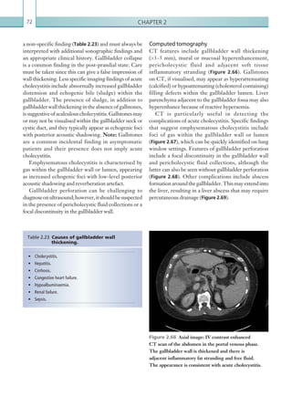 Chapter 272
Computed tomography
CT features include gallbladder wall thickening
(3–5 mm), mural or mucosal hyperenhancement,
pericholecystic fluid and adjacent soft tissue
inflammatory stranding (Figure 2.66). Gallstones
on CT, if visualised, may appear as hyperattenuating
(calcified) or hypoattenuating (cholesterol containing)
filling defects within the gallbladder lumen. Liver
parenchyma adjacent to the gallbladder fossa may also
hyperenhance because of reactive hyperaemia.
CT is particularly useful in detecting the
complications of acute cholecystitis. Specific findings
that suggest emphysematous cholecystitis include
foci of gas within the gallbladder wall or lumen
(Figure 2.67), which can be quickly identified on lung
window settings. Features of gallbladder perforation
include a focal discontinuity in the gallbladder wall
and pericholecystic fluid collections, although the
latter can also be seen without gallbladder perforation
(Figure 2.68). Other complications include abscess
formationaroundthegallbladder.Thismayextendinto
the liver, resulting in a liver abscess that may require
percutaneous drainage (Figure 2.69).
a non-specific finding (Table 2.23) and must always be
interpreted with additional sonographic findings and
an appropriate clinical history. Gallbladder collapse
is a common finding in the post-prandial state. Care
must be taken since this can give a false impression of
wall thickening. Less specific imaging findings of acute
cholecystitis include abnormally increased gallbladder
distension and echogenic bile (sludge) within the
gallbladder. The presence of sludge, in addition to
gallbladder wall thickening in the absence of gallstones,
is suggestive of acalculous cholecystitis. Gallstones may
or may not be visualised within the gallbladder neck or
cystic duct, and they typically appear as echogenic foci
with posterior acoustic shadowing. Note: Gallstones
are a common incidental finding in asymptomatic
patients and their presence does not imply acute
cholecystitis.
Emphysematous cholecystitis is characterised by
gas within the gallbladder wall or lumen, appearing
as increased echogenic foci with low-level posterior
acoustic shadowing and reverberation artefact.
Gallbladder perforation can be challenging to
diagnoseonultrasound;however,itshouldbesuspected
in the presence of pericholecystic fluid collections or a
focal discontinuity in the gallbladder wall.
•	 Cholecystitis.
•	 Hepatitis.
•	 Cirrhosis.
•	 Congestive heart failure.
•	 Hypoalbuminaemia.
•	 Renal failure.
•	 Sepsis.
Table 2.23 Causes of gallbladder wall
thickening.
Figure 2.66  Axial image: IV contrast enhanced
CT scan of the abdomen in the portal venous phase.
The gallbladder wall is thickened and there is
­adjacent inflammatory fat stranding and free fluid.
The ­appearance is consistent with acute cholecystitis.
K22247_C002.indd 72 16/05/15 3:07 AM
 