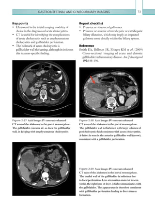 Gastrointestinal and genitourinary imaging 73
Key points
•	 Ultrasound is the initial imaging modality of
choice in the diagnosis of acute cholecystitis.
•	 CT is useful for identifying the complications
of acute cholecystitis such as emphysematous
cholecystitis and gallbladder perforation.
•	 The hallmark of acute cholecystitis is
gallbladder wall thickening, although in isolation
this is a ­non-specific finding.
Figure 2.67  Axial image: IV contrast enhanced
CT scan of the abdomen in the portal venous phase.
The gallbladder contains air, as does the gallbladder
wall, in keeping with emphysematous cholecystitis
Figure 2.68  Axial image: IV contrast enhanced
CT scan of the abdomen in the portal venous phase.
The gallbladder wall is thickened with large volumes of
pericholecystic fluid consistent with acute cholecystitis.
A defect is seen in the anterior gallbladder wall (arrow),
consistent with a gallbladder perforation.
Figure 2.69  Axial image: IV contrast enhanced
CT scan of the abdomen in the portal venous phase.
The medial wall of the gallbladder is indistinct due
to local perforation. Low attenuation material is seen
within the right lobe of liver, which communicates with
the gallbladder. This appearance is therefore consistent
with gallbladder perforation leading to liver abscess
formation.
Report checklist
•	 Presence or absence of gallstones.
•	 Presence or absence of intrahepatic or extrahepatic
biliary dilatation, which may imply an impacted
gallstone more distally within the biliary system.
Reference
Smith EA, Dillman JR, Elsayes KM et al. (2009)
Cross-sectional imaging of acute and chronic
gallbladder inflammatory disease. Am J Roentgenol
192:188–196.
K22247_C002.indd 73 16/05/15 3:07 AM
 