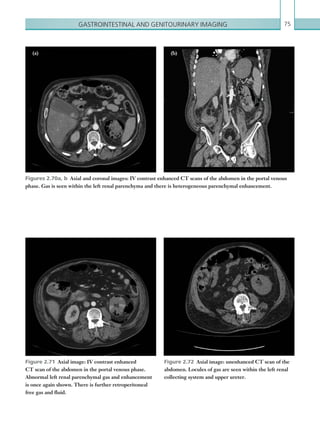 Gastrointestinal and genitourinary imaging 75
Figures 2.70a, b  Axial and coronal images: IV contrast enhanced CT scans of the abdomen in the portal venous
phase. Gas is seen within the left renal parenchyma and there is heterogeneous parenchymal enhancement.
Figure 2.71  Axial image: IV contrast enhanced
CT scan of the abdomen in the portal venous phase.
­Abnormal left renal parenchymal gas and enhancement
is once again shown. There is further retroperitoneal
free gas and fluid.
Figure 2.72  Axial image: unenhanced CT scan of the
abdomen. Locules of gas are seen within the left renal
collecting system and upper ureter.
(a) (b)
K22247_C002.indd 75 16/05/15 3:07 AM
 