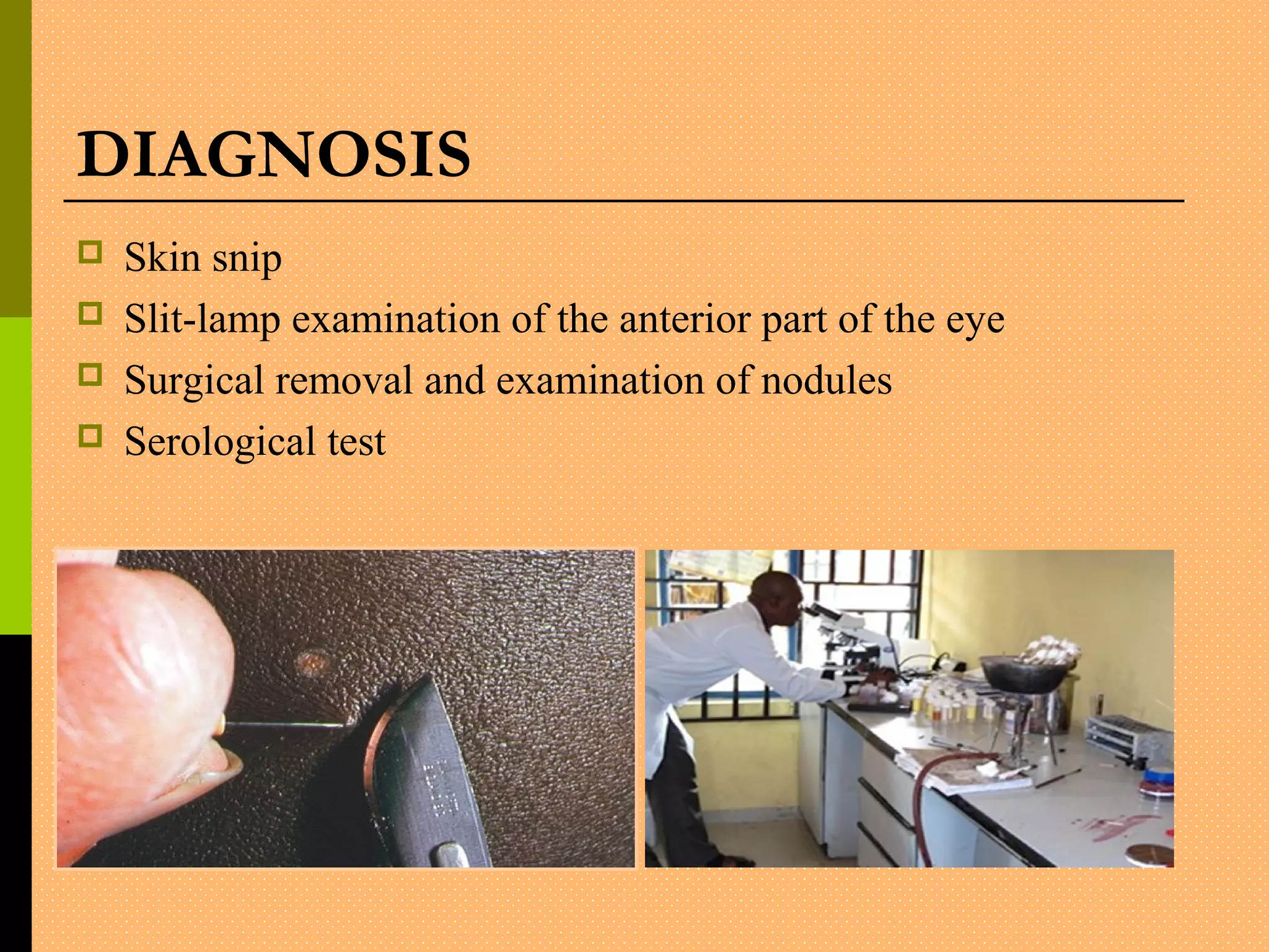 DIAGNOSIS
 Skin snip
 Slit-lamp examination of the anterior part of the eye
 Surgical removal and examination of nodules
 Serological test
 