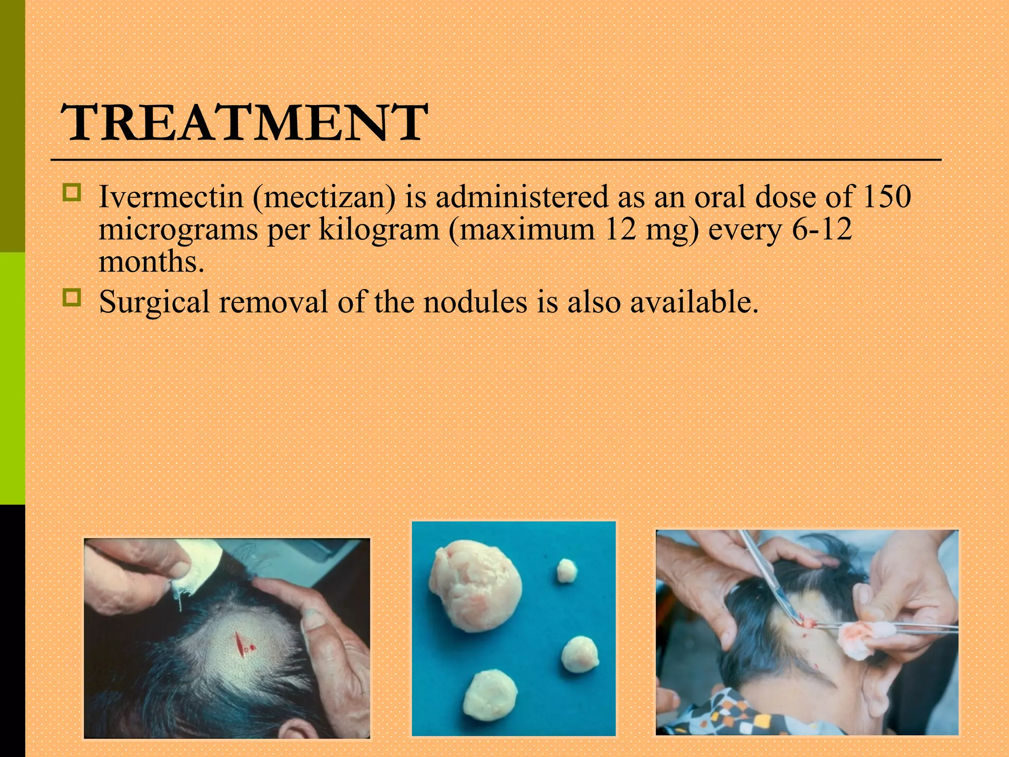 TREATMENT
 Ivermectin (mectizan) is administered as an oral dose of 150
micrograms per kilogram (maximum 12 mg) every 6-12
months.
 Surgical removal of the nodules is also available.
 