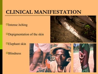 CLINICAL MANIFESTATION
Intense itching
Depigmentation of the skin
Elephant skin
Blindness
 