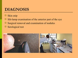 DIAGNOSIS
 Skin snip
 Slit-lamp examination of the anterior part of the eye
 Surgical removal and examination of nodules
 Serological test
 