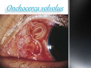 Onchocerca volvolus
 