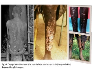 Fig. 4: Depigmentation over the skin in later onchocerciasis (Leopard skin). 
Source: Google images. 
 