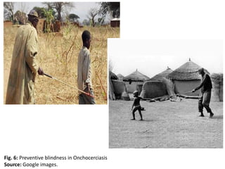 Fig. 6: Preventive blindness in Onchocerciasis 
Source: Google images. 
 