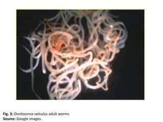 Fig. 3: Onchocerca volvulus adult worms 
Source: Google images. 
 