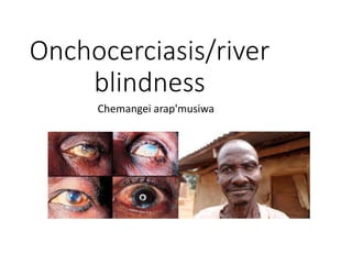 Onchocerciasis/river
blindness
Chemangei arap'musiwa
 