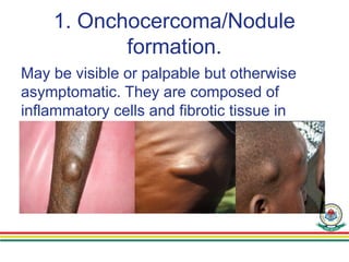 1. Onchocercoma/Nodule
formation.
May be visible or palpable but otherwise
asymptomatic. They are composed of
inflammatory cells and fibrotic tissue in
various proportions. Old nodules may
caseate or calsify.
 