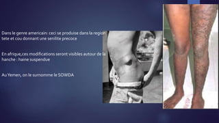 Dans le genre americain: ceci se produise dans la region
tete et cou donnant une senilite precoce
En afrique,ces modifications seront visibles autour de la
hanche : haine suspendue
AuYemen, on le surnomme le SOWDA
 