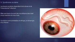 V. Syndrome oculaire
Les lesions oculaires dependent de la duree et de
l’intensite de l’ infection
Elles sont dues a la mort des microfilaires dans l’œil
et aux reactions du tissu hote.
Ces lesions sont semblables en Afrique, en Amerique
et auYemen…
 