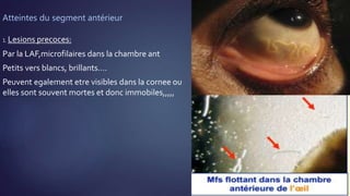 Atteintes du segment antérieur
1. Lesions precoces:
Par la LAF,microfilaires dans la chambre ant
Petits vers blancs, brillants….
Peuvent egalement etre visibles dans la cornee ou
elles sont souvent mortes et donc immobiles,,,,,
 