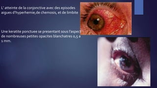 L’ atteinte de la conjonctive avec des episodes
aigues d’hyperhemie,de chemosis, et de limbite
Une keratite ponctuee se presentant sous l’aspect
de nombreuses petites opacites blanchatres 0,5 a
1 mm.
 