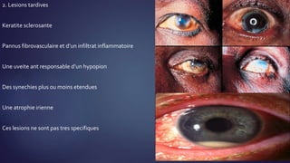 2. Lesions tardives
Keratite sclerosante
Pannus fibrovasculaire et d’un infiltrat inflammatoire
Une uveite ant responsable d’un hypopion
Des synechies plus ou moins etendues
Une atrophie irienne
Ces lesions ne sont pas tres specifiques
 