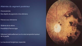 Atteintes du segment postérieur
Chorioretinite
Des dépôts de pigments intra rétiniens
Fibrose sous rétinienne
Œdème de la rétine
Possibilité d’hemorragie
Débutent habituellement sur le cote temporal et autour
de la papille
La macula est longtemps respectée
 