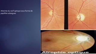 Atteinte du nerf optique sous forme de
papillite subaigues
 