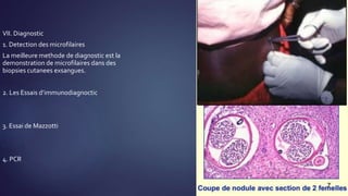 VII. Diagnostic
1. Detection des microfilaires
La meilleure methode de diagnostic est la
demonstration de microfilaires dans des
biopsies cutanees exsangues.
2. Les Essais d’immunodiagnoctic
3. Essai de Mazzotti
4. PCR
 