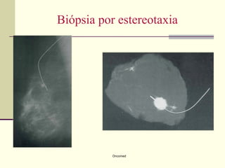 Biópsia por estereotaxia




           Oncomed
 