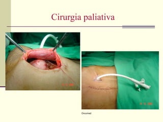Cirurgia paliativa




        Oncomed
 