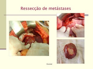 Ressecção de metástases




           Oncomed
 