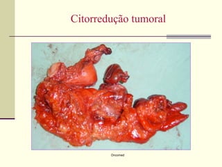 Citorredução tumoral




        Oncomed
 
