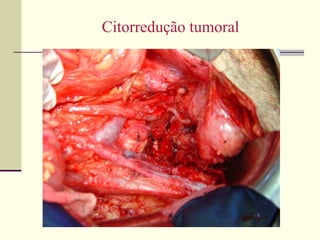 Citorredução tumoral




        Oncomed
 
