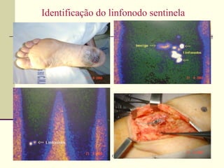Identificação do linfonodo sentinela




                 Oncomed
 