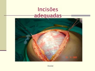 Incisões
adequadas




    Oncomed
 