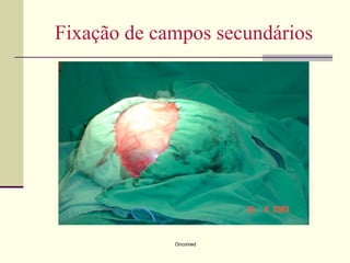 Fixação de campos secundários




             Oncomed
 