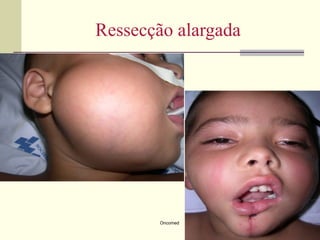 Ressecção alargada




       Oncomed
 