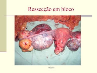 Ressecção em bloco




        Oncomed
 