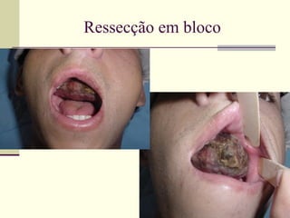 Ressecção em bloco




        Oncomed
 