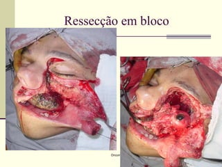 Ressecção em bloco




        Oncomed
 
