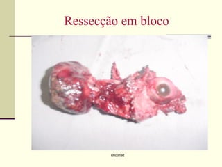 Ressecção em bloco




        Oncomed
 