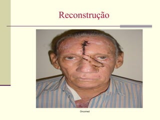 Reconstrução




     Oncomed
 